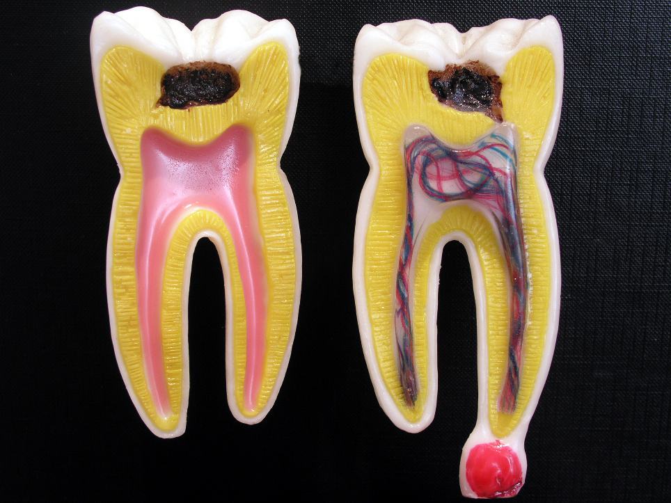 A model of a tooth